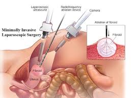 Laparoscopic Treatment